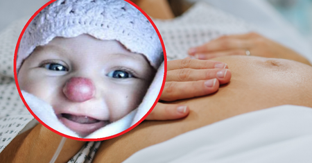 Nazywali ją "dziewczynką z nosem klauna". Tak dziś wygląda 16-latka