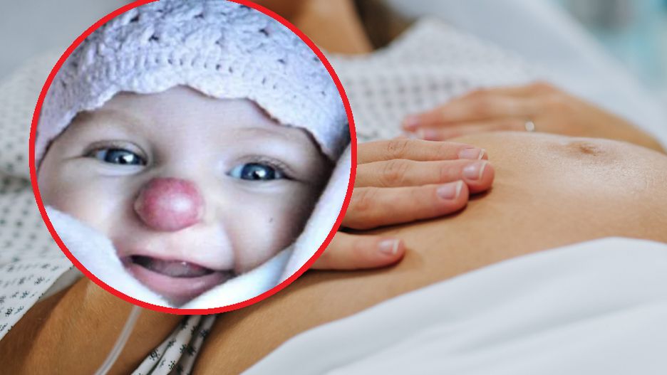 Dziewczynka z "nosem klauna" ma już 16 lat. Jak dziś wygląda?