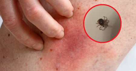 Coraz więcej Polaków z boreliozą. Wybierają niebezpieczną metodę leczenia