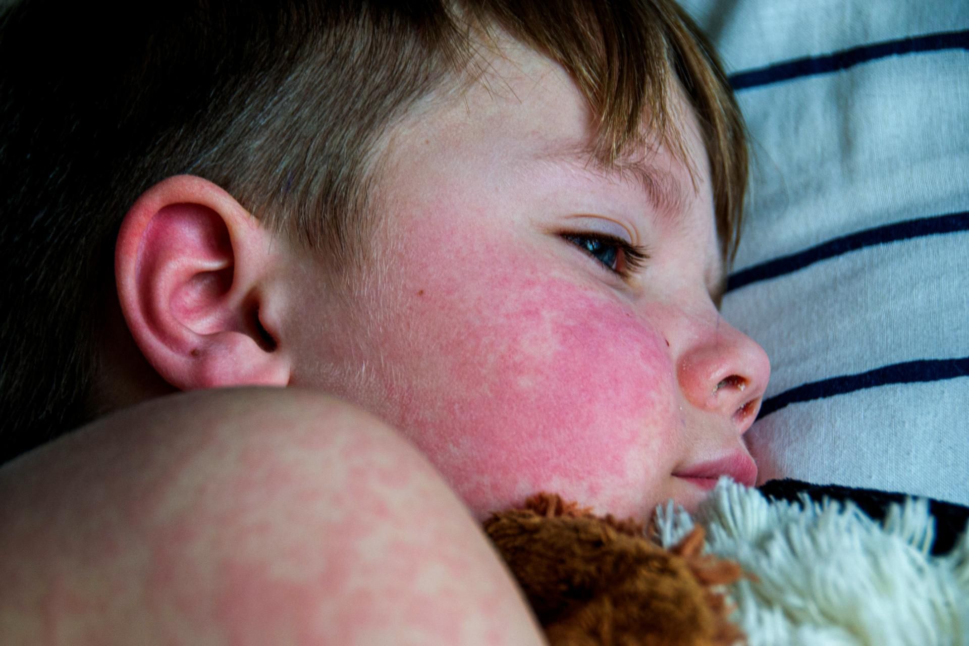 Epidemia odry czyha za rogiem