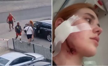 Brutalne pobicie młodej pary. 20-latka dostała ciosy w twarz za akcent