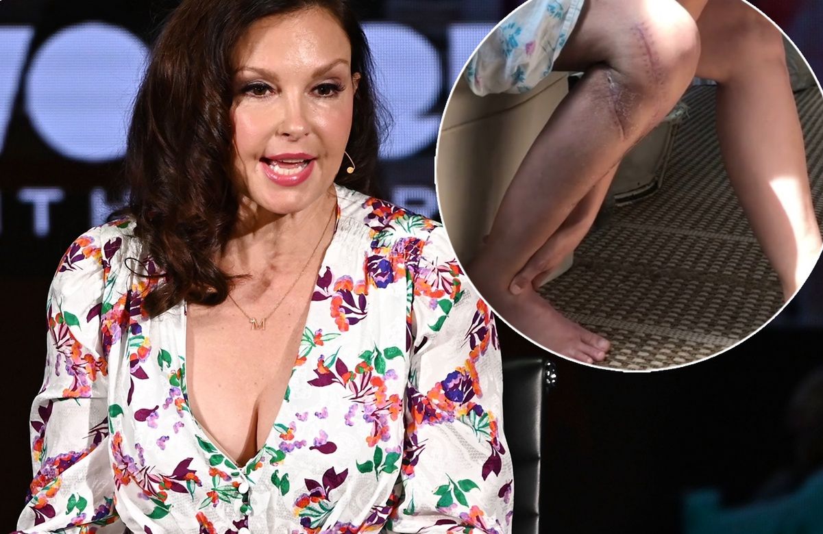 Ashley Judd ledwo uszła z życiem. Pokazała pokiereszowane nogi