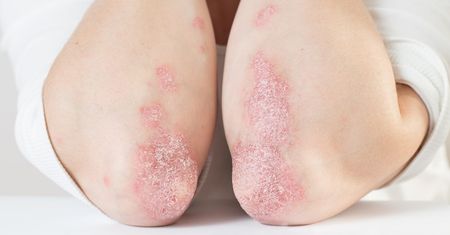 Choroby skóry – objawy, rodzaje, diagnostyka i leczenie