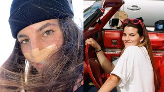 Pitbull ODGRYZŁ WARGĘ modelce z Arizony. Kobieta pokazuje, jak teraz wygląda jej twarz (FOTO)