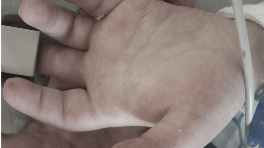 Sine dłonie mogą być objawem COVID