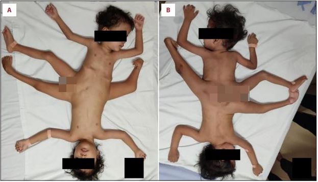 Tak wyglądali chłopcy przed operacją