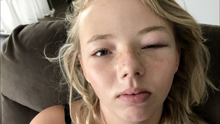 Dziewczyna doznała silnej reakcji alergicznej