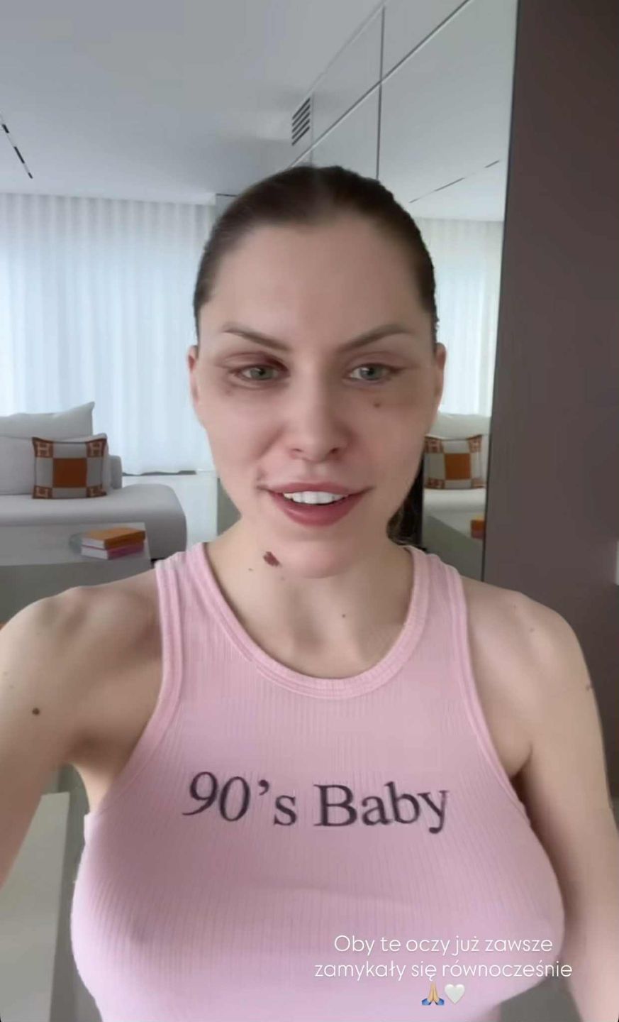 Julia von Stein pokazała zliftingowaną twarz 13 dni po operacji