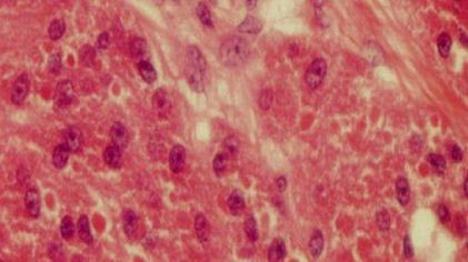 Nanocząstki do zwalczania raka, jakich jeszcze nie było 1