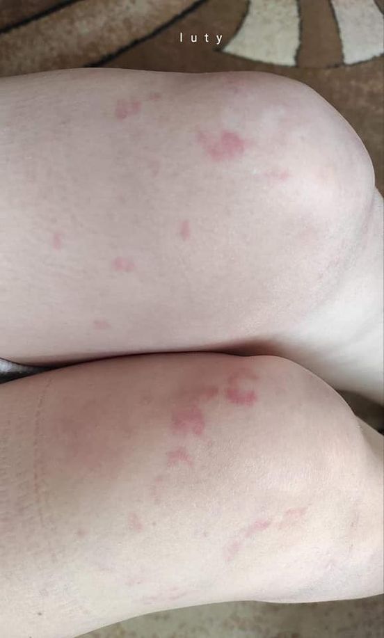 Lekarze nie wiedzą, jak długo mogą się utrzymywać pokrzywki po przejściu COVID