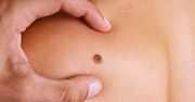 Nowotwór łatwo pomylić ze zwykłą zmianą skórną. Zobacz, jak odróżnić czerniaka