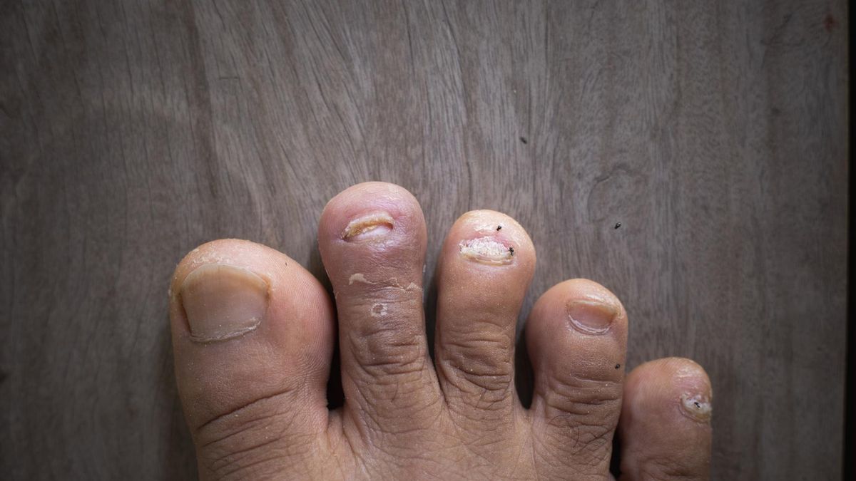 Objaw wysokiego cholesterolu, który dostrzeżesz na paznokciach stóp