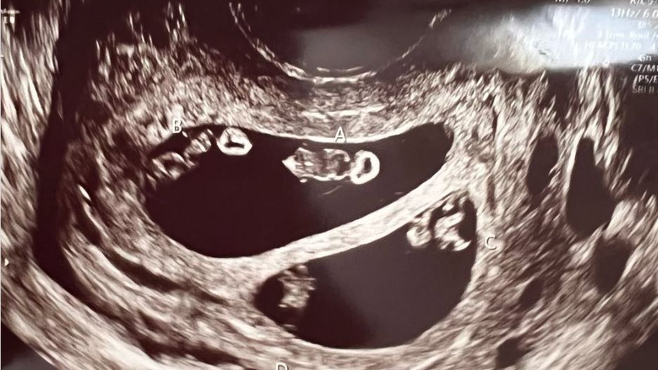 Taki przypadek zdarza się raz na kilka milionów. Urodziła dwie pary identycznych bliźniąt