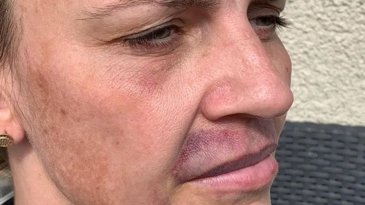 Wypełniacz do ust oszpecił twarz kobiety