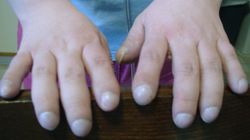 Nietypowy objaw raka płuc. Obserwuj swoje palce