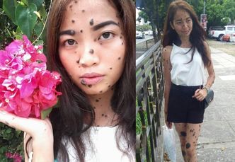 20-letnia Malezyjka ma całe ciało pokryte pieprzykami i znamionami. Chce zostać... Miss Universe! (ZDJĘCIA)