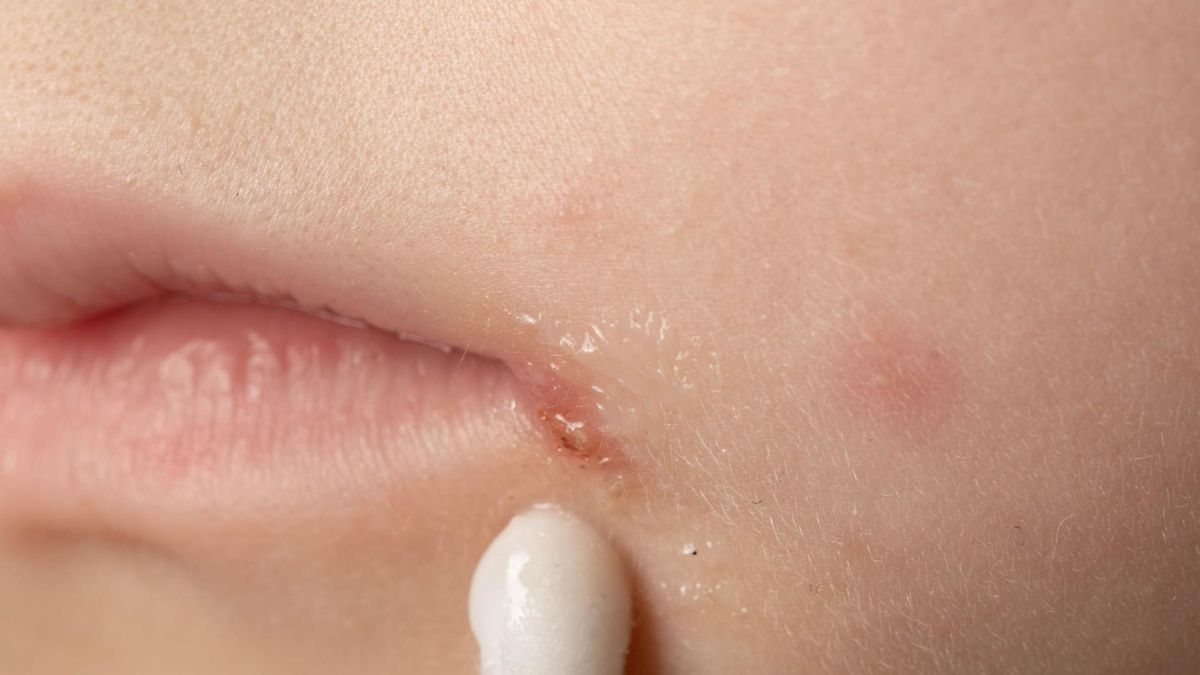 Maści na zajady pozwalają leczyć stan zapalny kącików ust.