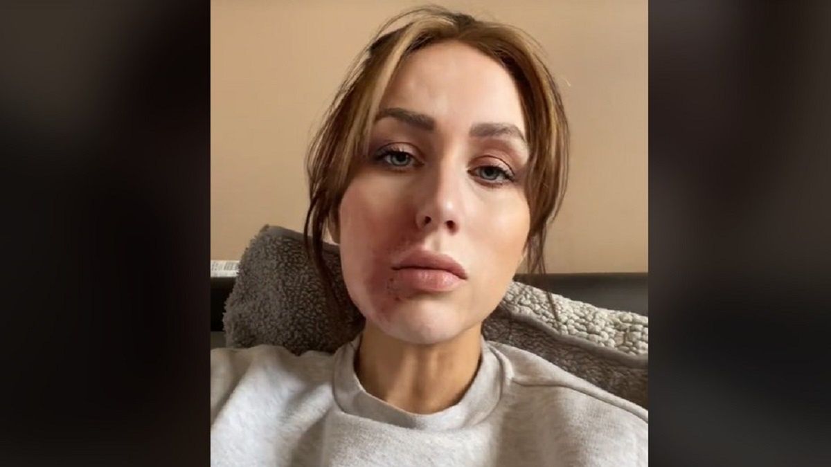 30-latka poparzona w pubie. Stała się gwiazdą internetu. 