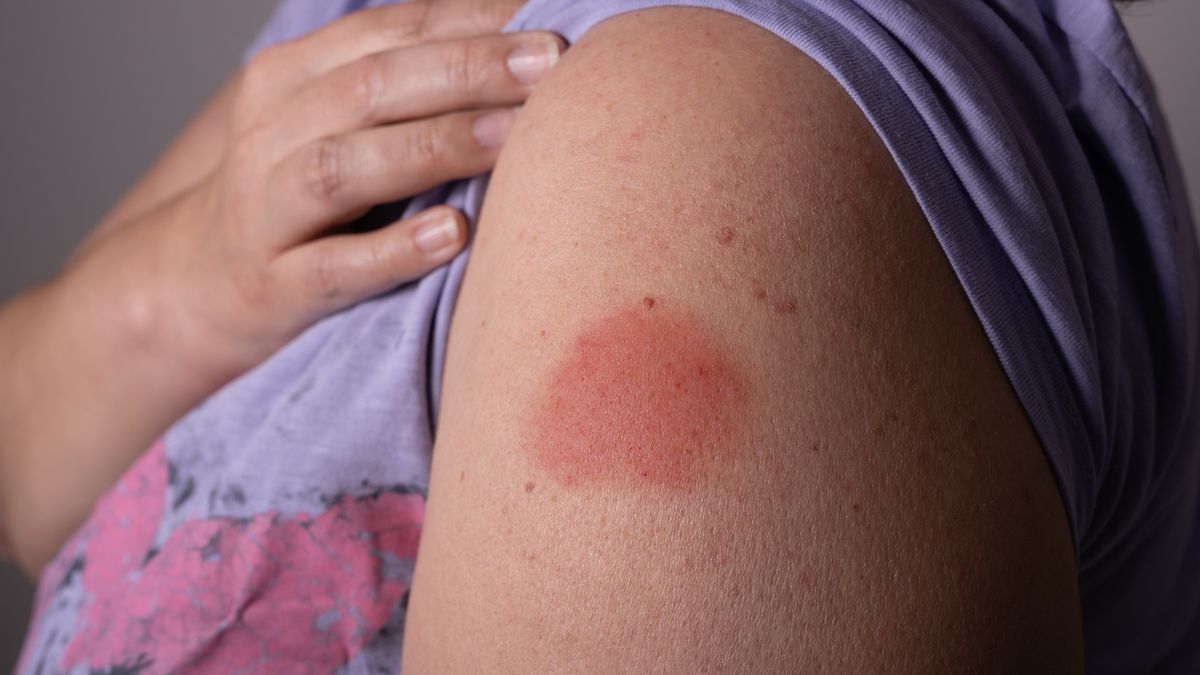 Redness after a Covid vaccination with a vaccineredness after a Moderna Covid vaccination that can occur.Toonix