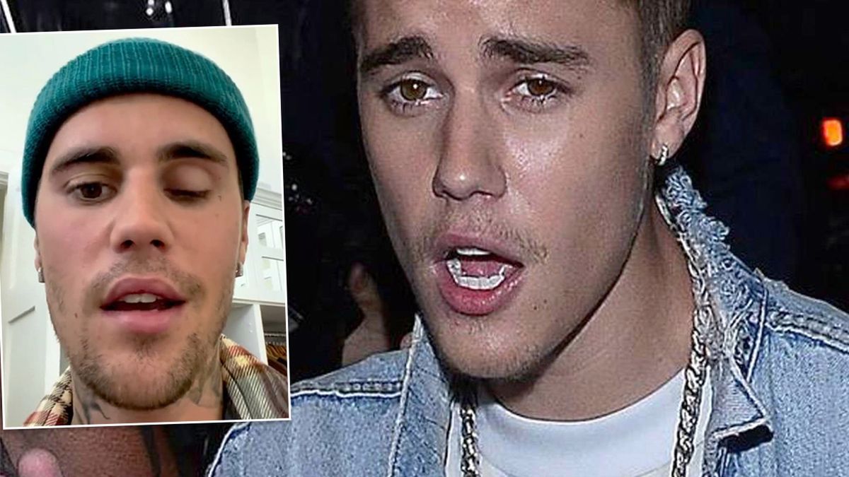 Justin Bieber ma poważne problemy zdrowotne. Pokazał fanom sparaliżowaną twarz. To dlatego odwołuje koncerty