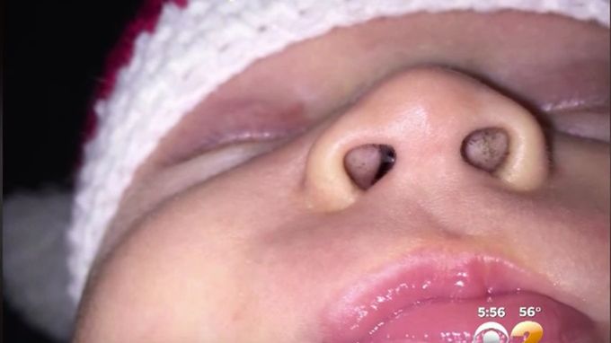 Czarne kropki w nosku