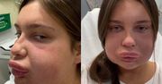 Chciała powiększyć usta. Oto, jak wygląda po zabiegu