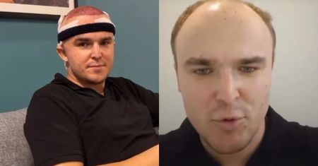Kamil z "Rolnik szuka żony" pofatygował się do Turcji po włosy. Tak teraz wygląda  [ZDJĘCIA]
