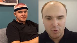 Kamil z "Rolnik szuka żony" pofatygował się do Turcji po włosy. Tak teraz wygląda  [ZDJĘCIA]