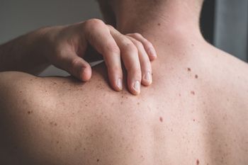 Przez lata rozwija się po cichu. Pierwsze objawy choroby widać na skórze