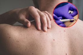Prawie dwukrotnie więcej przypadków nowotworu. Jego ryzyko rośnie latem