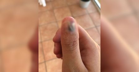 Obgryzanie paznokci może mieć poważne konsekwencje. Studentka straciła palec