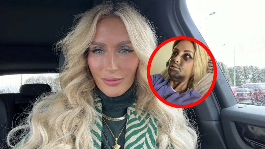 Powikłania po implancie zęba pojawiły się dzień po zabiegu