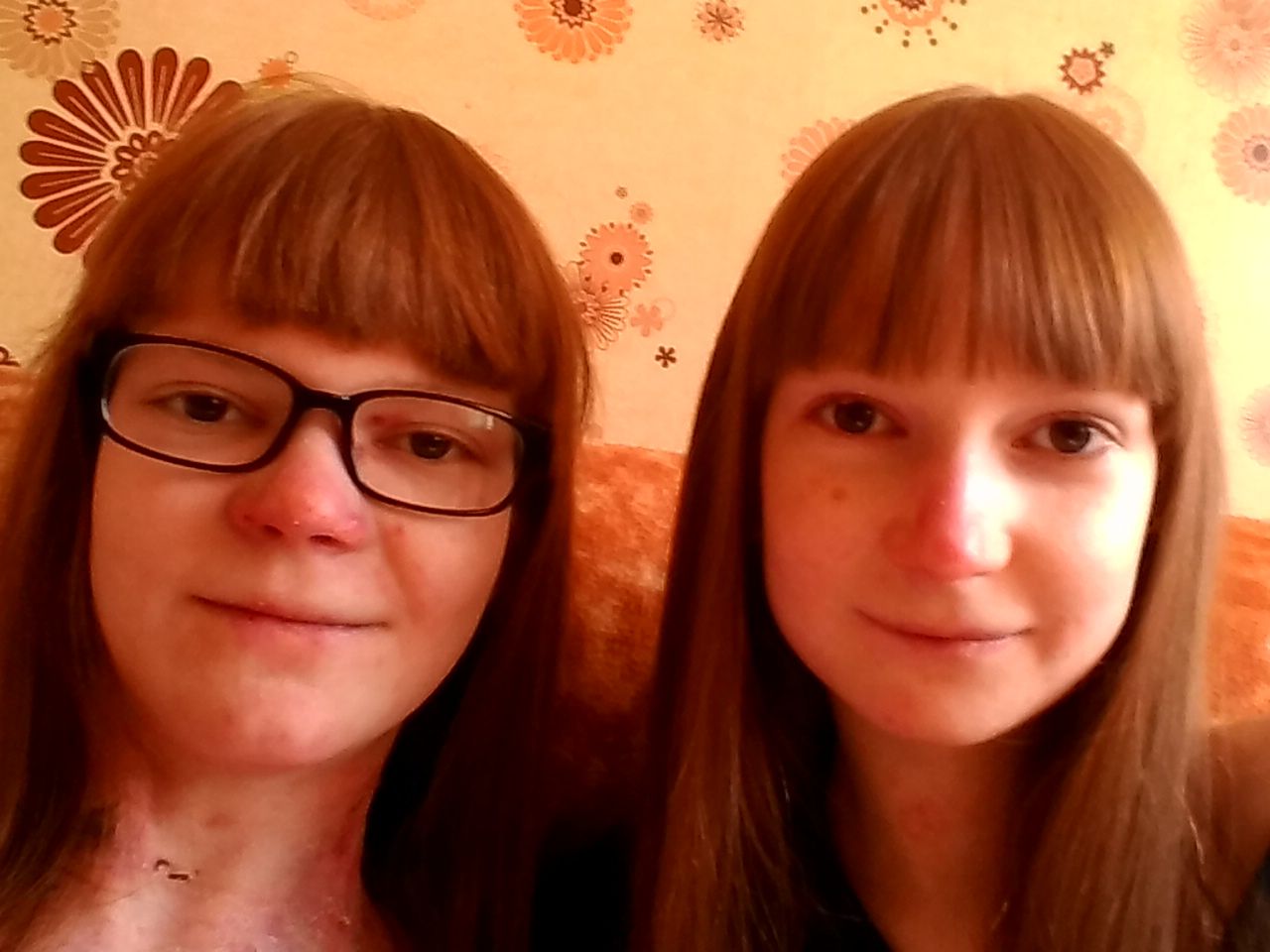 Agata i Patrycja walczą z pęcherzowym oddzielaniem się naskórka od urodzenia