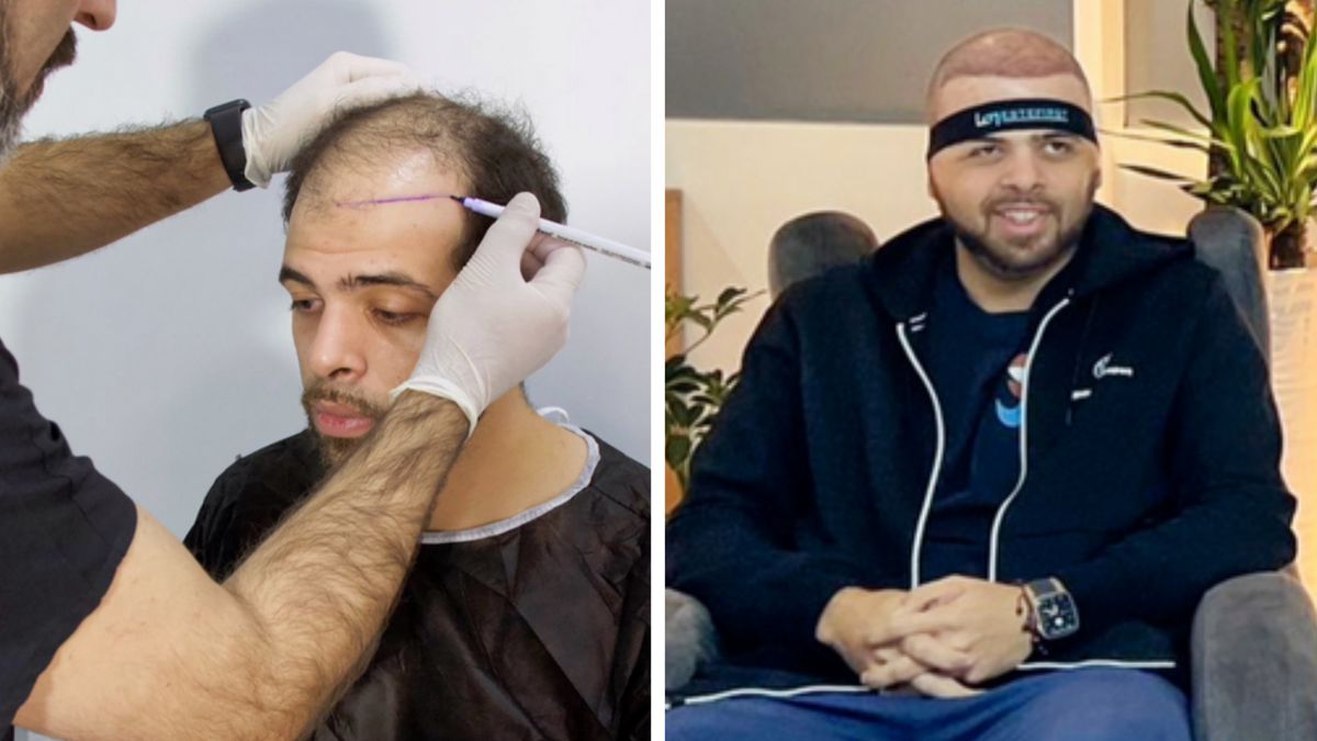 Poddał się zabiegowi przeszczepu włosów. Tak zmieniła się jego twarz.