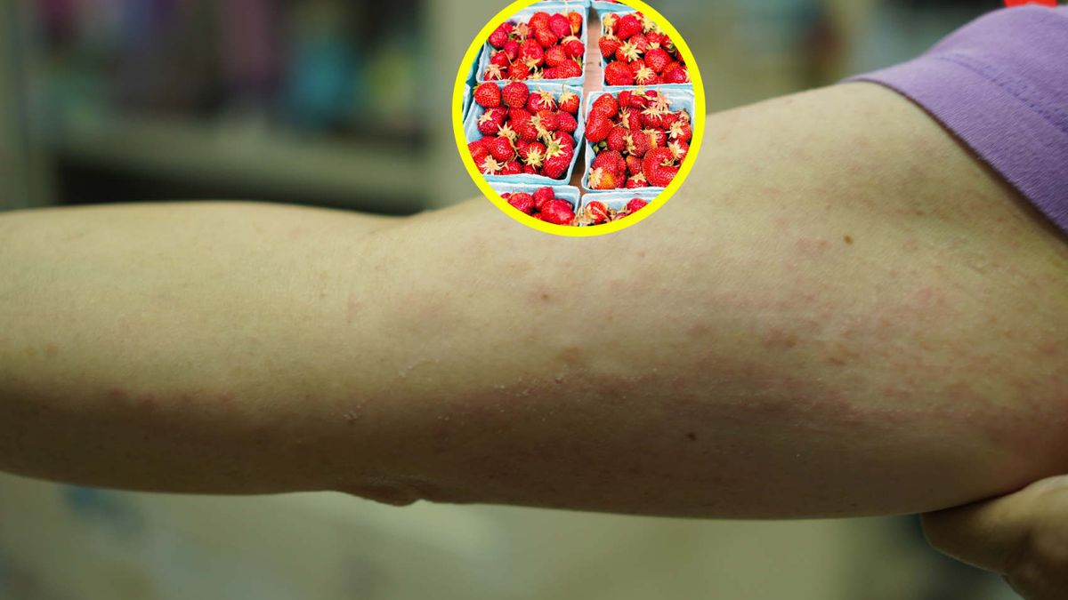 Pojawia się podczas jedzenia truskawek. Uważaj, tak może objawiać się alergia