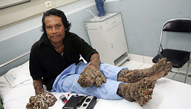 Dede Koswara w szpitalu