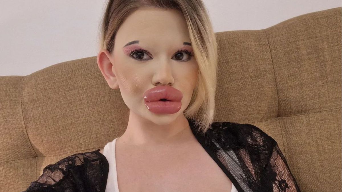 24-latka powiększyła biust i systematycznie wstrzykuje kwas hialuronowy w usta