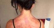 Czerwone pręgi na plecach. Tak wygląda ciało przepracowanej fryzjerki