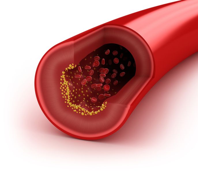 Wysoki cholesterol może doprowadzić do zatoru żył.