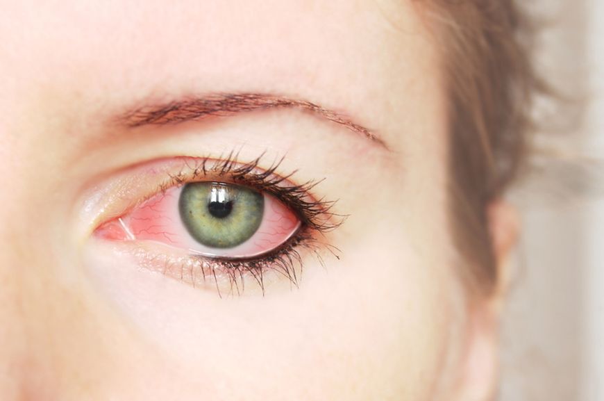 Jaskra inaczej glaukoma to choroba charakteryzująca się patologicznym wzrostem ciśnienia wewnątrz gałki ocznej.