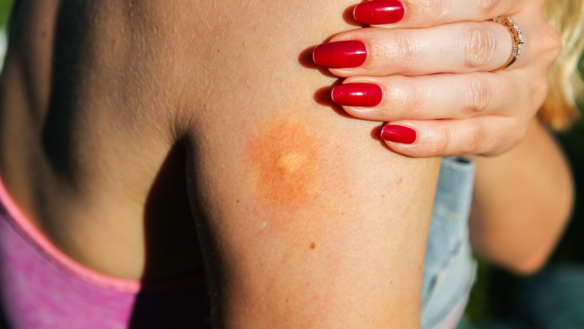 Mosquito bite on the shoulder. Insects in the summer. Dangerous nature. Itchy arm.Mosquito bite on the shoulder. Insects in the summer. Dangerous nature. Itchy arm.Vadym  Plysiukache, allergic, background, bed, bite, bites, bug, health, intense, itch, itchiness, itchy, medical, problem, rash, scratch, sore, treatment, white, woman