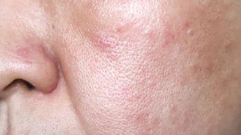 "Dziurki" zaczną znikać. Wystarczy produkt z domowej apteczki