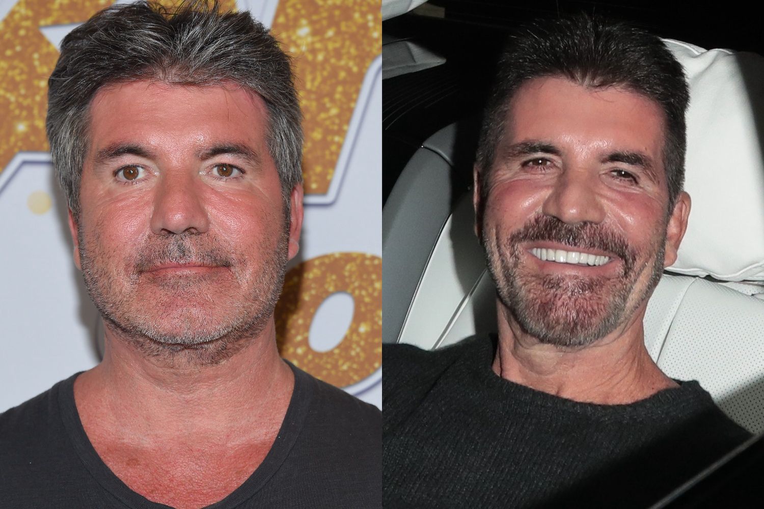 Simon Cowell i operacje plastyczne