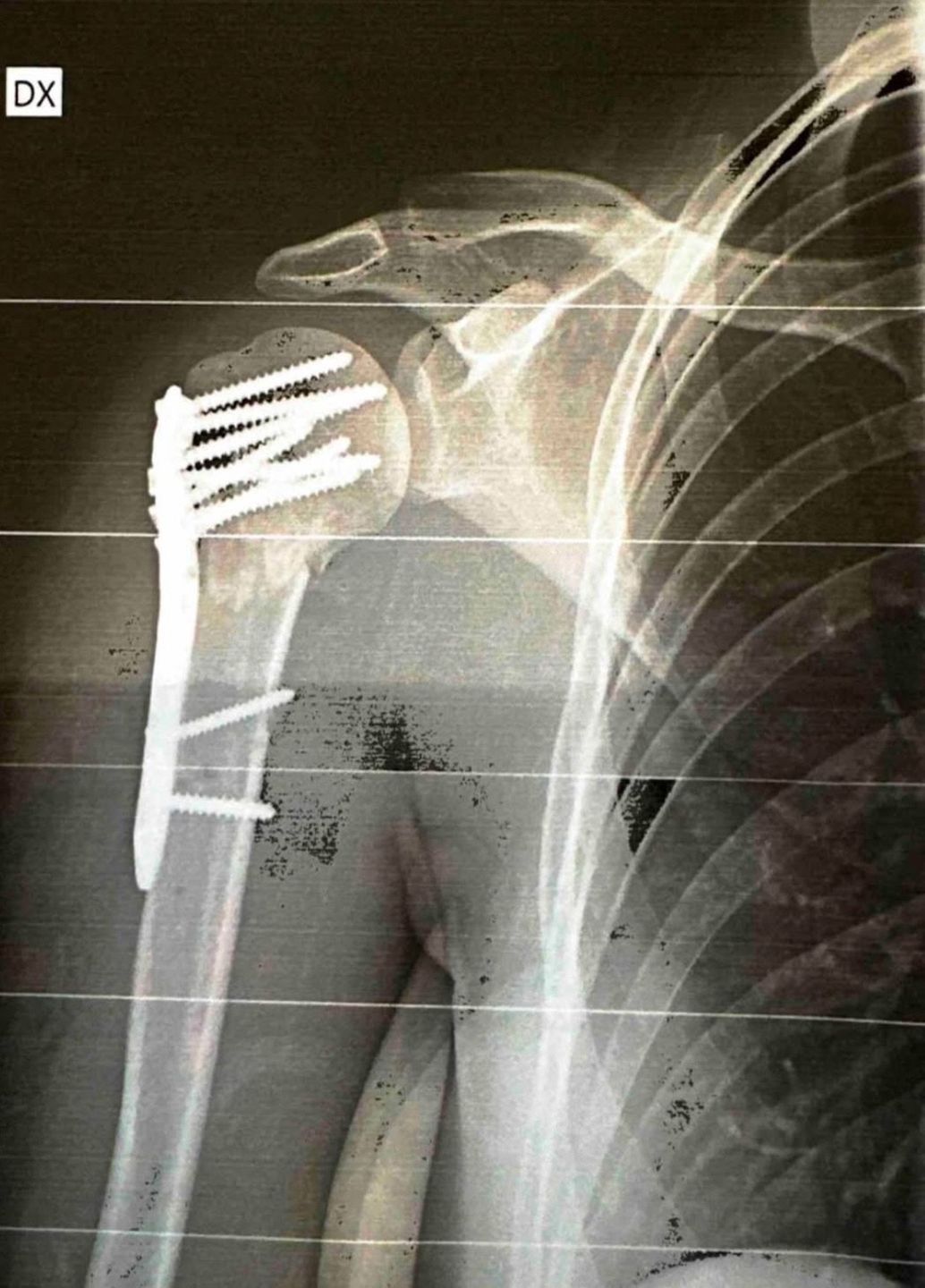 Zdjęcie rentgenowskie po operacji dziennikarki 