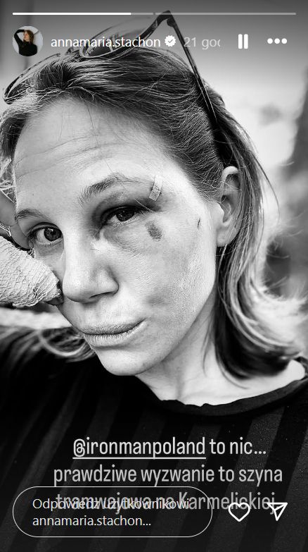 Anna-Maria Stachoń pokazała zdjęcia po wypadku