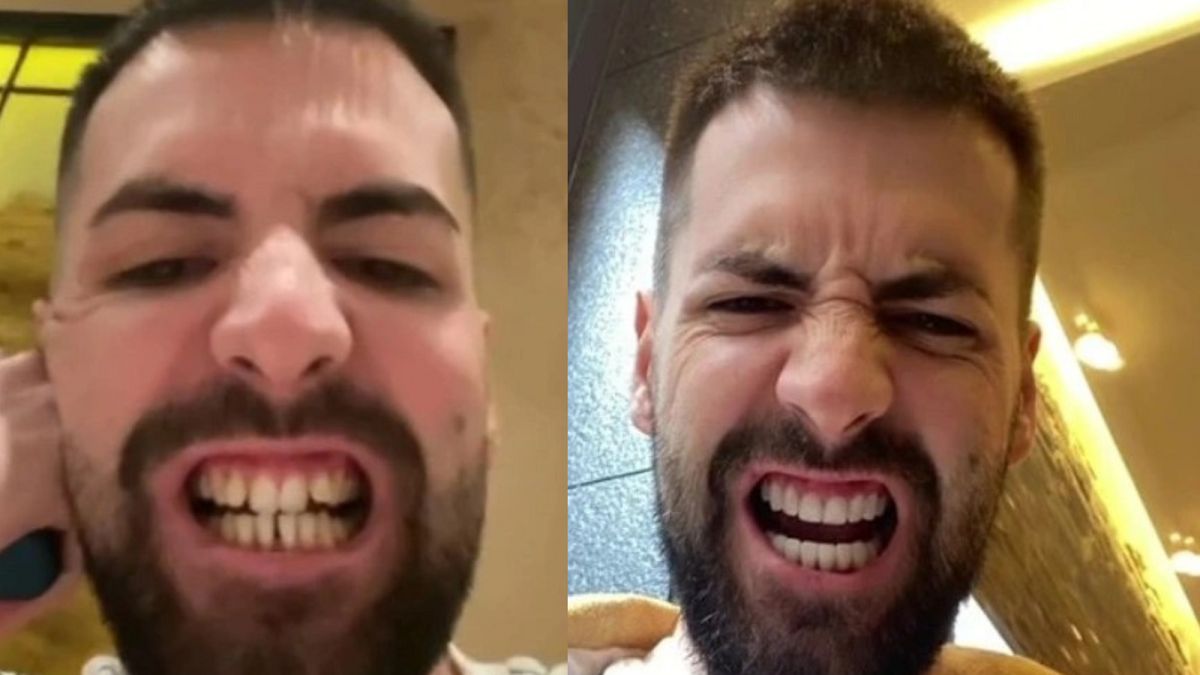 Zrobił sobie "tureckie zęby" 