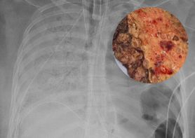 Koronawirus "wypalił" dziury w płucach 20-latki. Kobieta otrzymała podwójny przeszczep