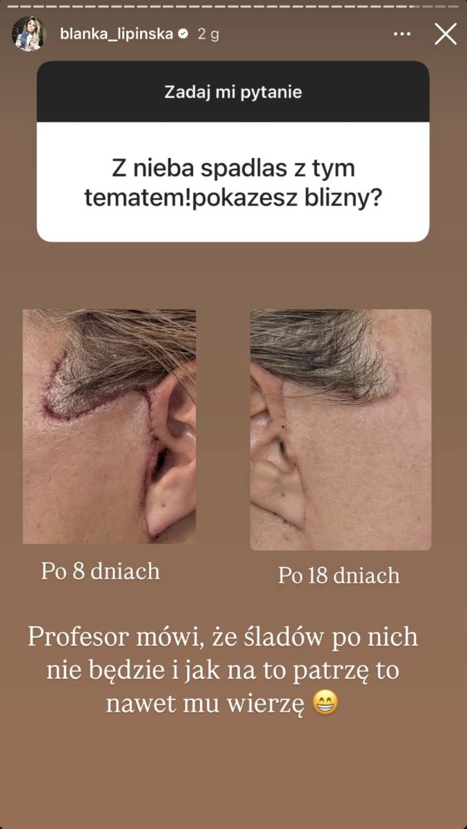 Blanka Lipińska pokazała blizny po liftingu 