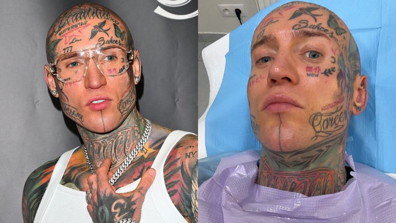 Stifler poddał się liposukcji podbródka