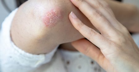 Przesuszona skóra na łokciach? Domowy kosmetyk zastąpi drogie kremy
